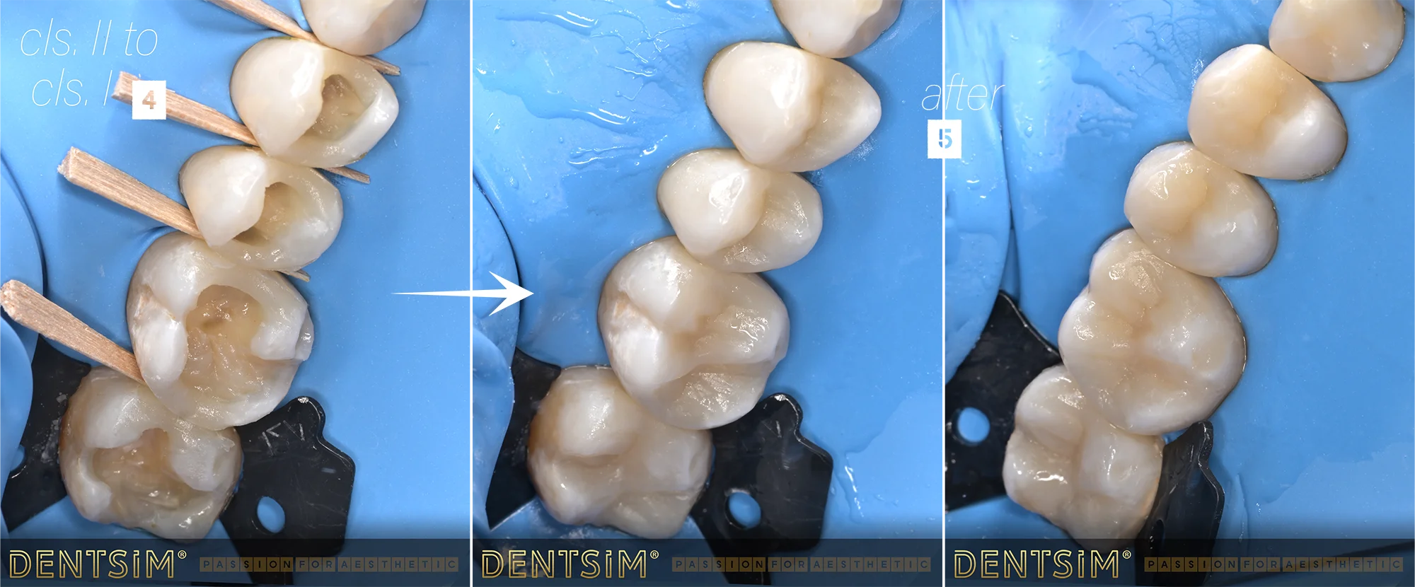 etapeplombe dentare
