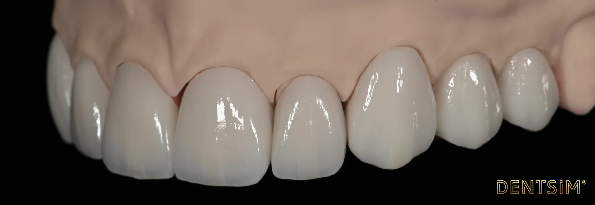 Implant dentar